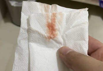 Is this implantation bleeding? 
