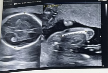Baby's kidneys holding fluid, gender and other such things.