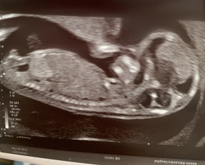 Going down a rabbit hole with nub theory (yes I know I am crazy) - Is this definitely a boy!
