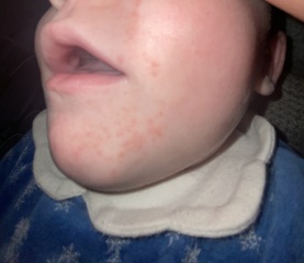 Does this look like a milk rash?