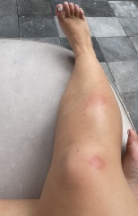 Horrendous mosquito bites abroad.. and currently TTC :(