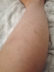 Heavy achy feeling Veiny legs 