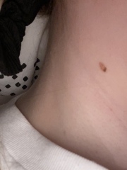 Two coloured mole on neck 