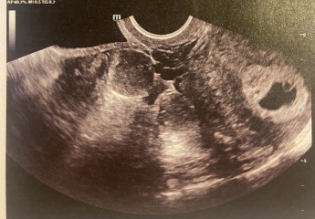 6 week scan no fetal pole
