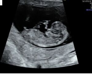 11 weeks 2 days can anyone help guess the sex of my baby 