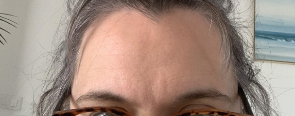 2 huge lines between brows - help