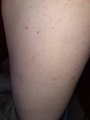 Rash on tighs