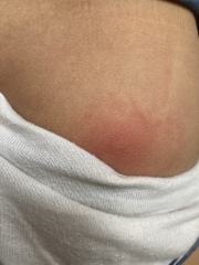 Itchy bumps and vomiting