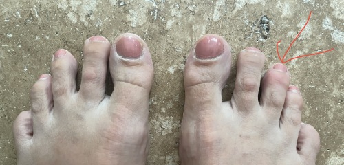 Broken toe 10 days later (pic)