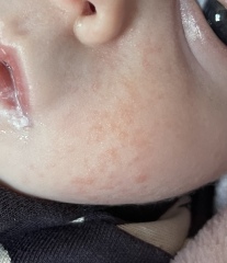 Possible CMPA rash/mucusy poo? (Pics)