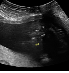 Ladies who have had a gender scan around 16 weeks 