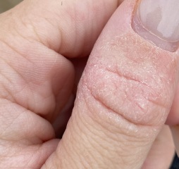 Stuck in an endless cycle of steroid cream - arghhh!!