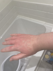 Hives all over body all of a sudden