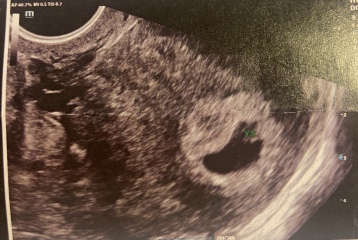 6 week scan no fetal pole