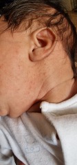 FTM... spots on baby