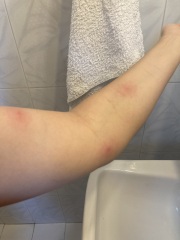Help Please - are these mosquito or bed bug bites 