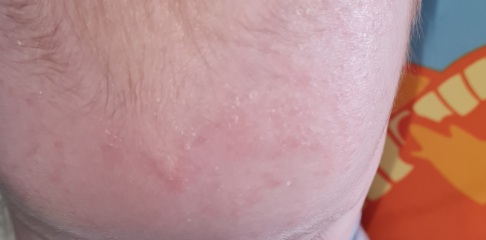 Advice re rash on face/head