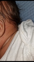 FTM .. Baby acne, heat rash or allergy??
