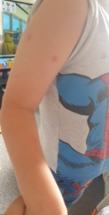 To ask if this is chickenpox?