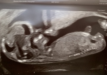 Going down a rabbit hole with nub theory (yes I know I am crazy) - Is this definitely a boy!