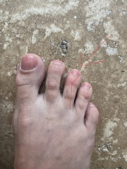 Broken toe 10 days later (pic)