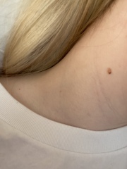 Two coloured mole on neck 