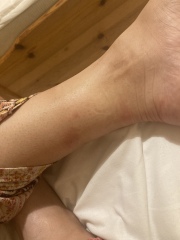 Help Please - are these mosquito or bed bug bites 