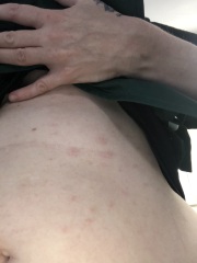 Rash on stomach