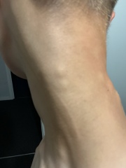 Teenager with ongoing back pain 