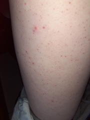 Rash on tighs
