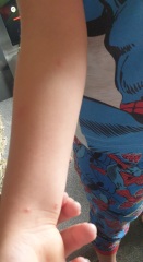 To ask if this is chickenpox?