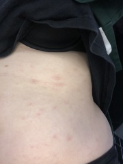Rash on stomach
