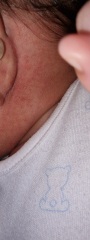 FTM... spots on baby