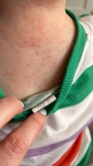 Toddler Rash