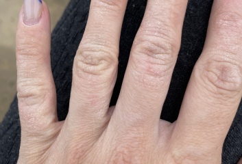 Stuck in an endless cycle of steroid cream - arghhh!!