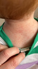Toddler Rash