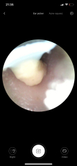 Is My Earwax Normal? (Pic)