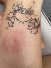 Horrendous mosquito bites abroad.. and currently TTC :(