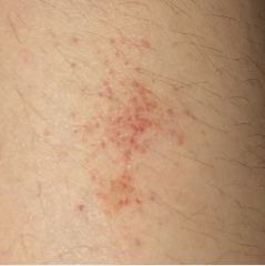 Teenager with ongoing back pain 
