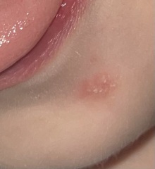 This isn't chickenpox right?