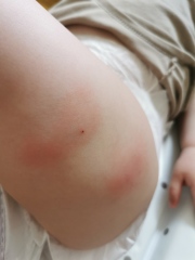 12 month jabs - sore legs