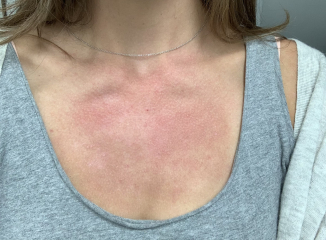 What is this rash? Pic