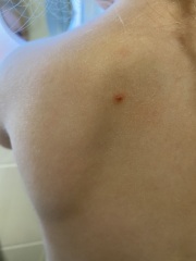 I am not convinced this is chickenpox....