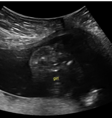 Ladies who have had a gender scan around 16 weeks 