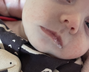 Possible CMPA rash/mucusy poo? (Pics)
