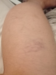 Heavy achy feeling Veiny legs 