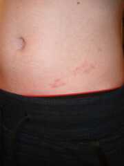 Son's rash. What is it? 
