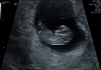 Babies Due April 2023 Thread 4 
