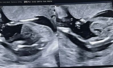 Baby's kidneys holding fluid, gender and other such things.