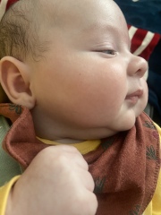 Baby rash on face 